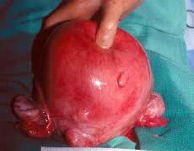 Cos’è il fibroma uterino e come trattarlo?